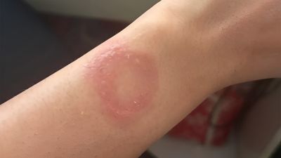 Владелец Apple Watch заявил об ожоге на запястье и пожаловался на отсутствие реакции Apple - playground.ru